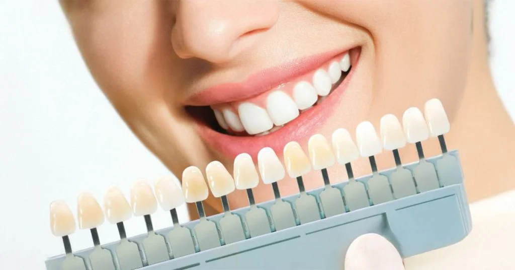 Porcelain Veneers for