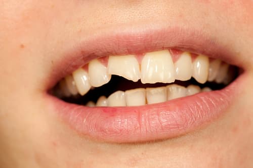 Broken or Chipped Tooth Care for
