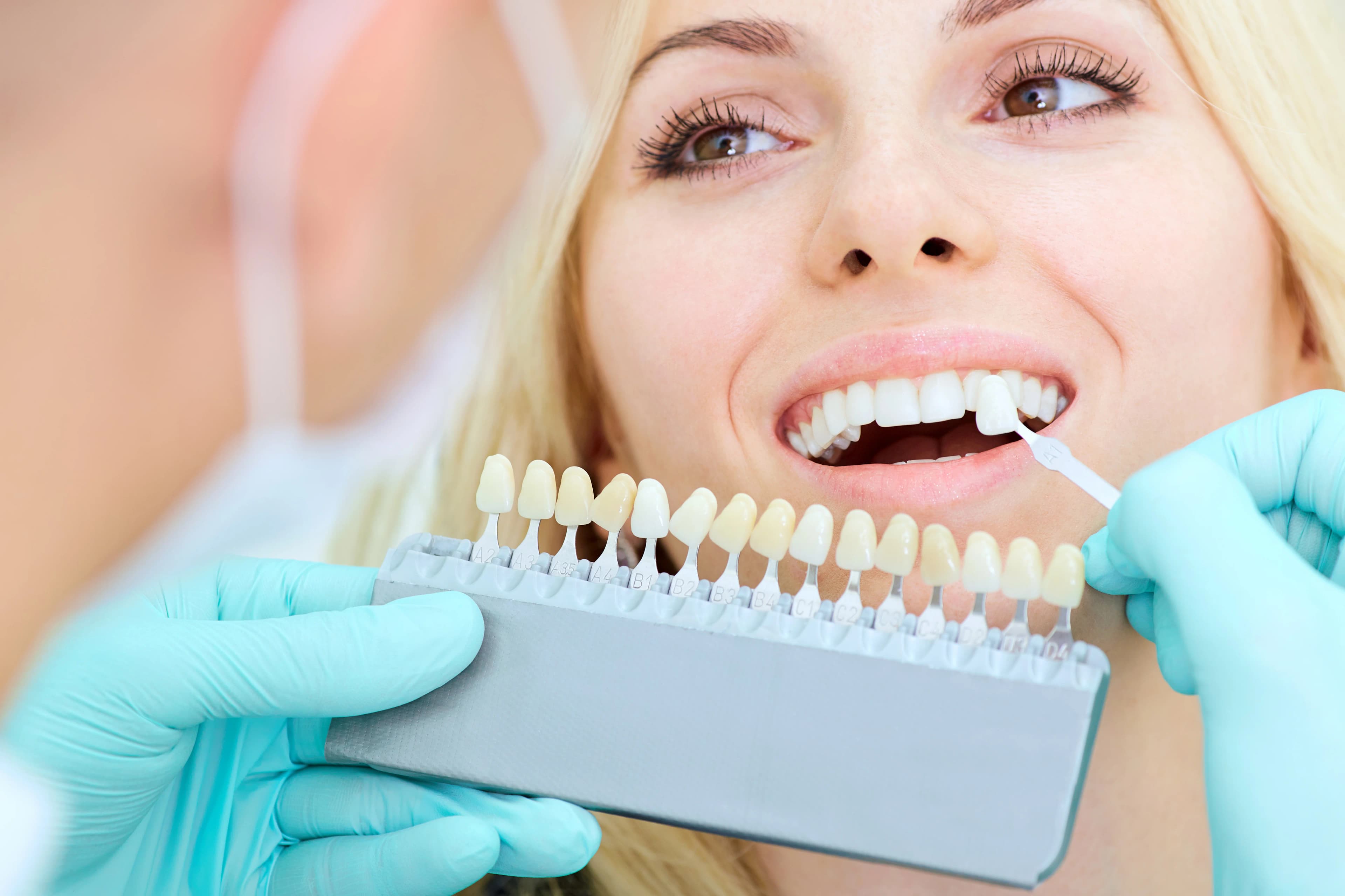 Professional Teeth Whitening for